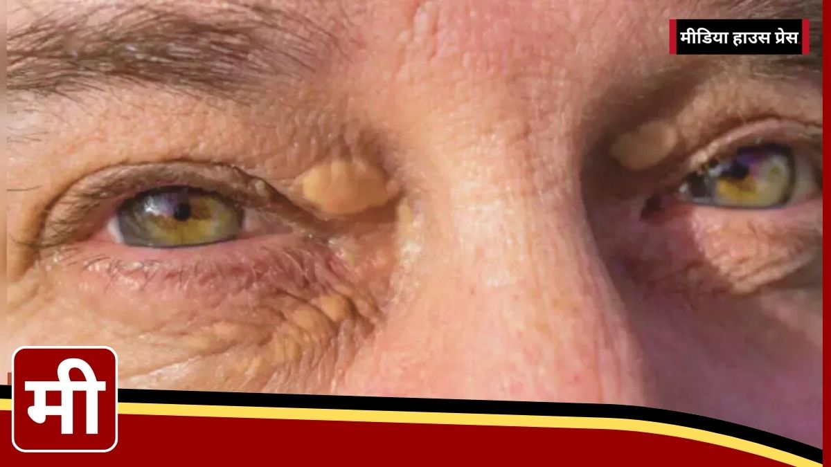 Xanthelasma: The Hidden Heart Health Warning Around Your Eyes